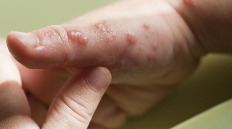 Dlaczego niektóre wirusy pozostają w ciele na zawsze?